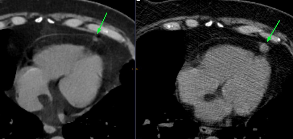 Pericardial metastases progression

🟪 More frequent than primary pericardial tumors
🟦Commonly occur from:
🟢 Breast cancer
🟡 Lung cancer
🟠 Renal cell carcinoma (this case)
🔴 Ovarian cancer
#FOAMed #FOAMrad #radiology #radtwitter #MedTwitter #chestrad