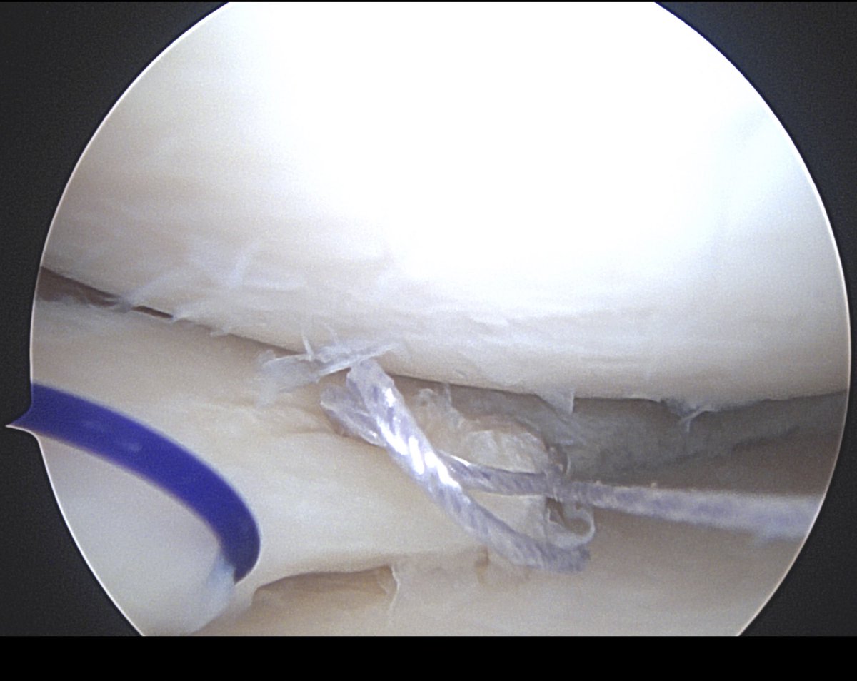 DrDeCampos's tweet photo. #buckethandletear #medialmeniscus left knee acute-on-chronic with anterior outside in and posterior anchors https://t.co/BNPgTi3A21