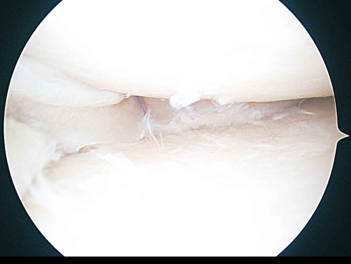 DrDeCampos's tweet photo. #buckethandletear #medialmeniscus left knee acute-on-chronic with anterior outside in and posterior anchors https://t.co/BNPgTi3A21