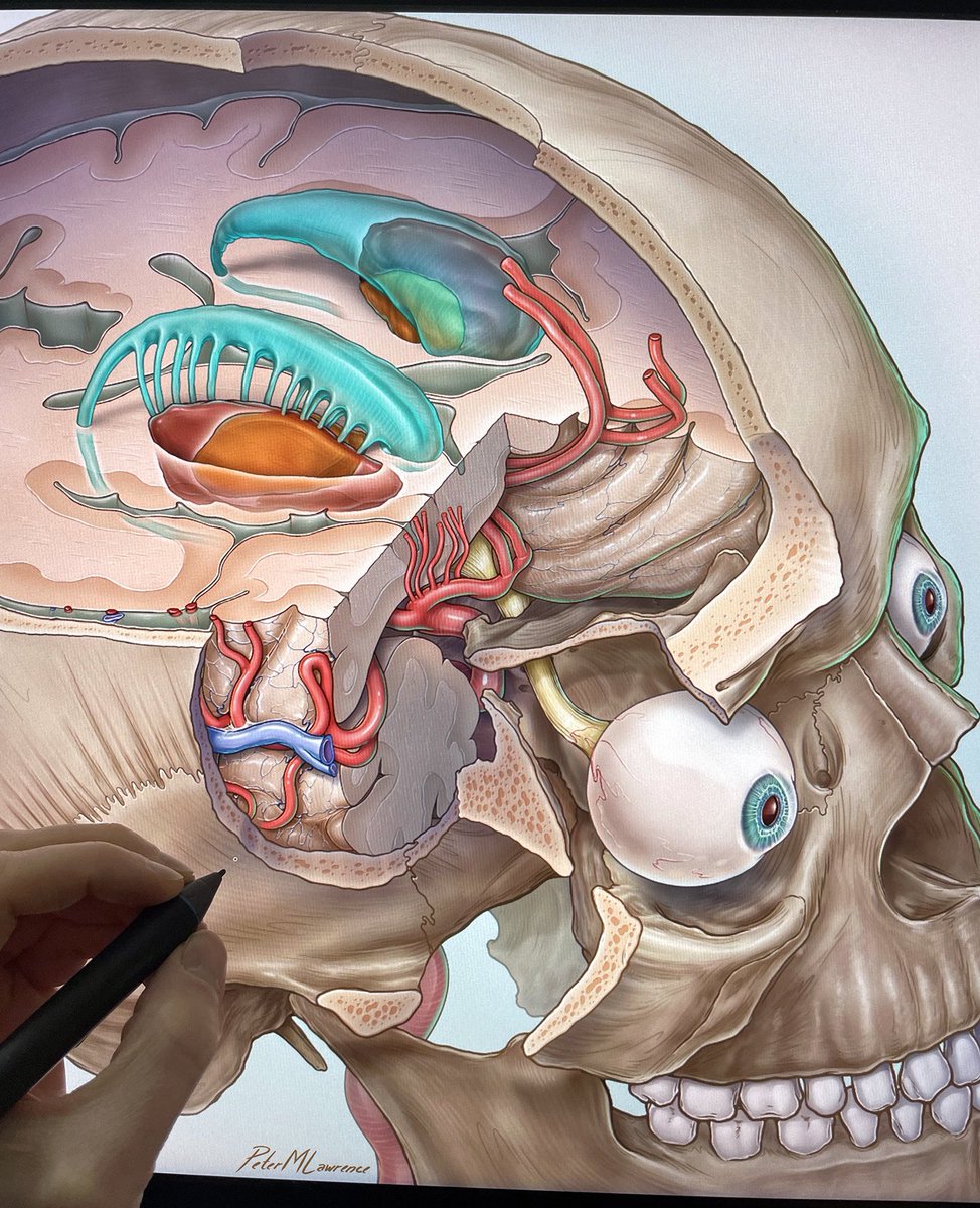 Work in progress. Illustration will depict multiple approaches to basal ganglia cavernomas <a href="/BarrowNeuro/">BarrowNeurological</a> <a href="/mtlawton/">Michael T. Lawton, MD</a> <a href="/OGdukeneurosurg/">Oren Gottfried, MD</a> <a href="/chrost_hugo/">Hugo Chrost</a>