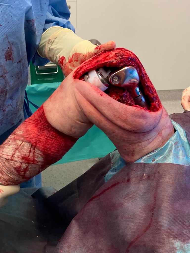 PabloCodesido's tweet photo. Así es una meta de adenocarcinoma pulmonar en la rodilla. Artroplastia tumoral.
A pulmonary adenocarc meta sited in the knee. Tumoral arthroplasty. https://t.co/dL911BsDbr