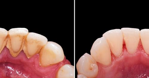 sumterdental's tweet photo. Deep dental cleaning is necessary for patients with gum disease. Before and after photos show the difference that this painless procedure can make.

#dentalcare #sumterdentalcare https://t.co/sWiwrPLc32