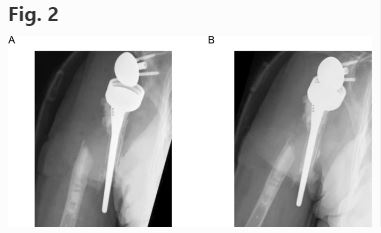 Concise Clinical Review in Osteoporosis International: 
Periprosthetic fractures: an unrecognized #osteoporosis crisis 
by Binkley et al.  rdcu.be/c8jJo