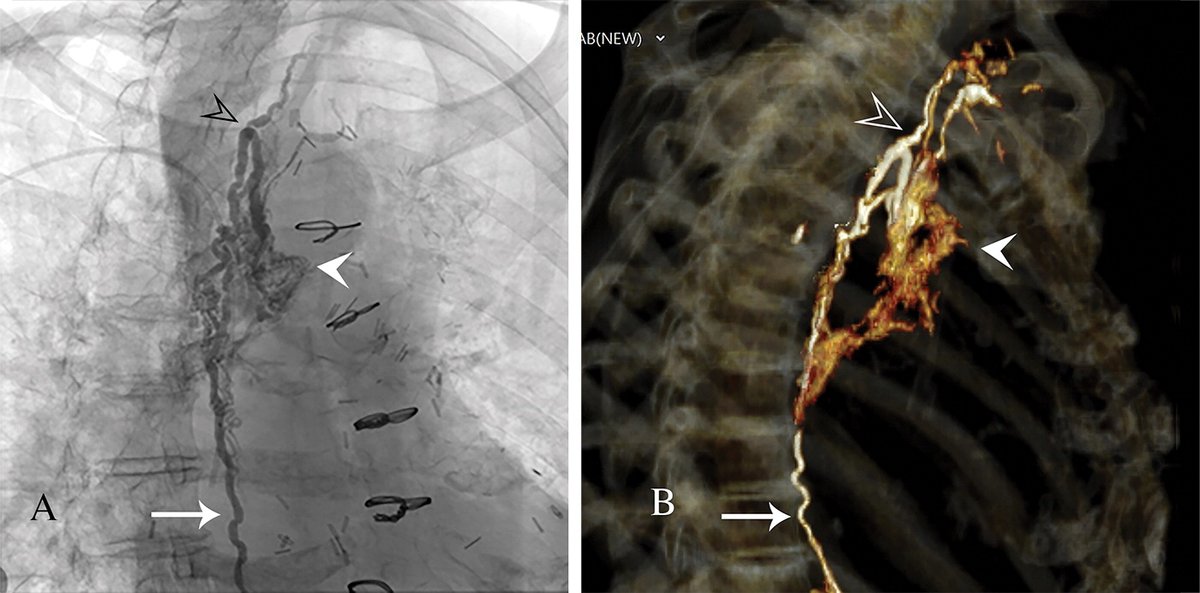 Normal lymphatic function is needed for body fluid homeostasis, and alterations in lymphatic flow can be seen in a variety of disorders, including chylothorax, chylous ascites, plastic bronchitis, protein-losing enteropathy, lymphedema, and chyluria. bit.ly/3yVNF6W