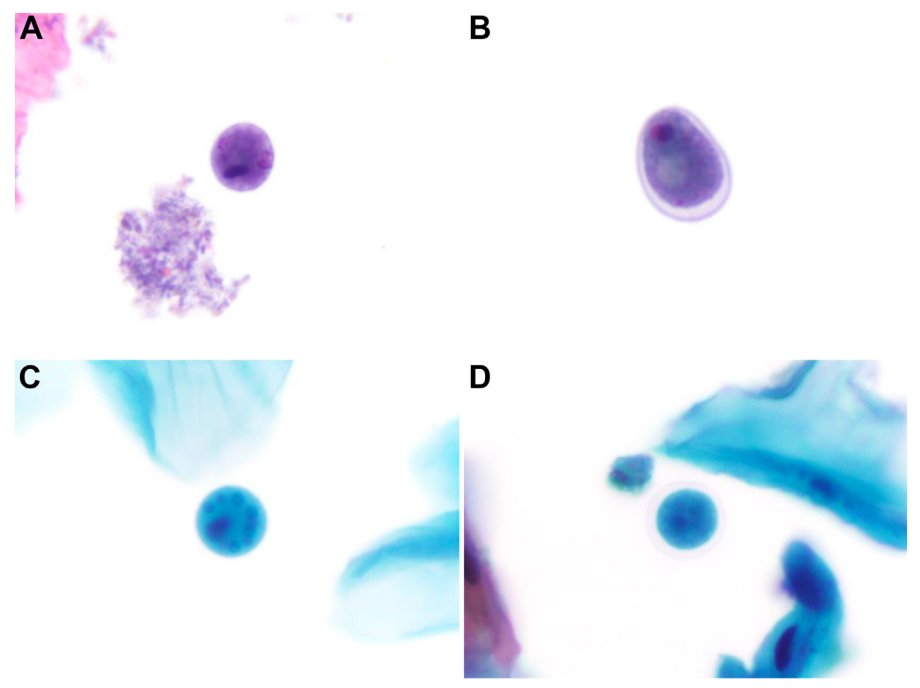 Vanda Torous MD (@vandatorousmd) on Twitter photo Ever wonder what is hiding in the background of anal pap tests? Well, you may be looking at an amoeba without knowing it!
If you'd like to learn more about detection of amoeba, check out our fresh off the press study 🦠
<a href="/MGHPathology/">MGH Pathology</a> <a href="/BIDMCpath/">BIDMC Pathology</a> #CytoPath #PathTwitter #PathBugs Ever wonder what is hiding in the background of anal pap tests? Well, you may be looking at an amoeba without knowing it!
If you'd like to learn more about detection of amoeba, check out our fresh off the press study 🦠
<a href="/MGHPathology/">MGH Pathology</a> <a href="/BIDMCpath/">BIDMC Pathology</a> #CytoPath #PathTwitter #PathBugs