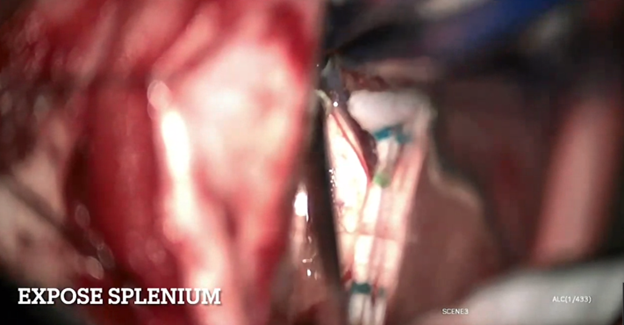 StevenBremMD's tweet photo. A transcallosal approach was the best suited for this bithalamic #cavmal, separating the internal cerebral veins.  Steps include: 1. Expose splenium; 2. Develop corridor between ICVs; 3. En Bloc Resection https://t.co/YNMMw6rv90