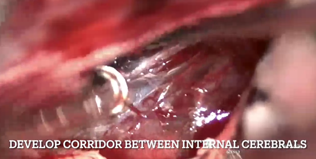 StevenBremMD's tweet photo. A transcallosal approach was the best suited for this bithalamic #cavmal, separating the internal cerebral veins.  Steps include: 1. Expose splenium; 2. Develop corridor between ICVs; 3. En Bloc Resection https://t.co/YNMMw6rv90