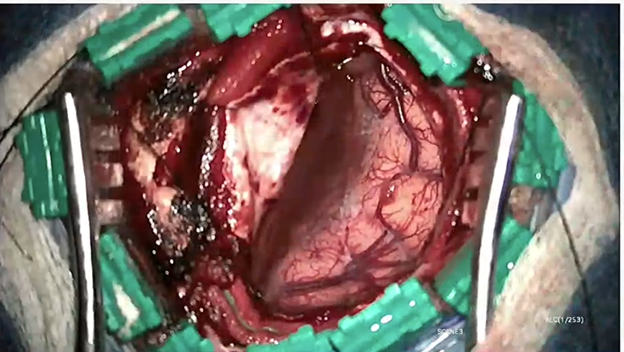StevenBremMD's tweet photo. A transcallosal approach was the best suited for this bithalamic #cavmal, separating the internal cerebral veins.  Steps include: 1. Expose splenium; 2. Develop corridor between ICVs; 3. En Bloc Resection https://t.co/YNMMw6rv90