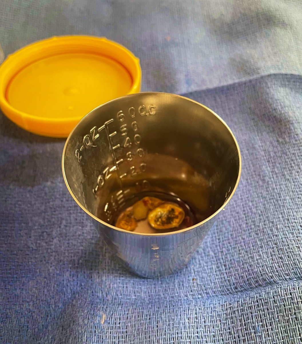 AMK_uro's tweet photo. Not many things are more satisfying than hearing that *clink* when dropping stones in a metal cup during PCNL 🤌 https://t.co/lcNBuFKyWs