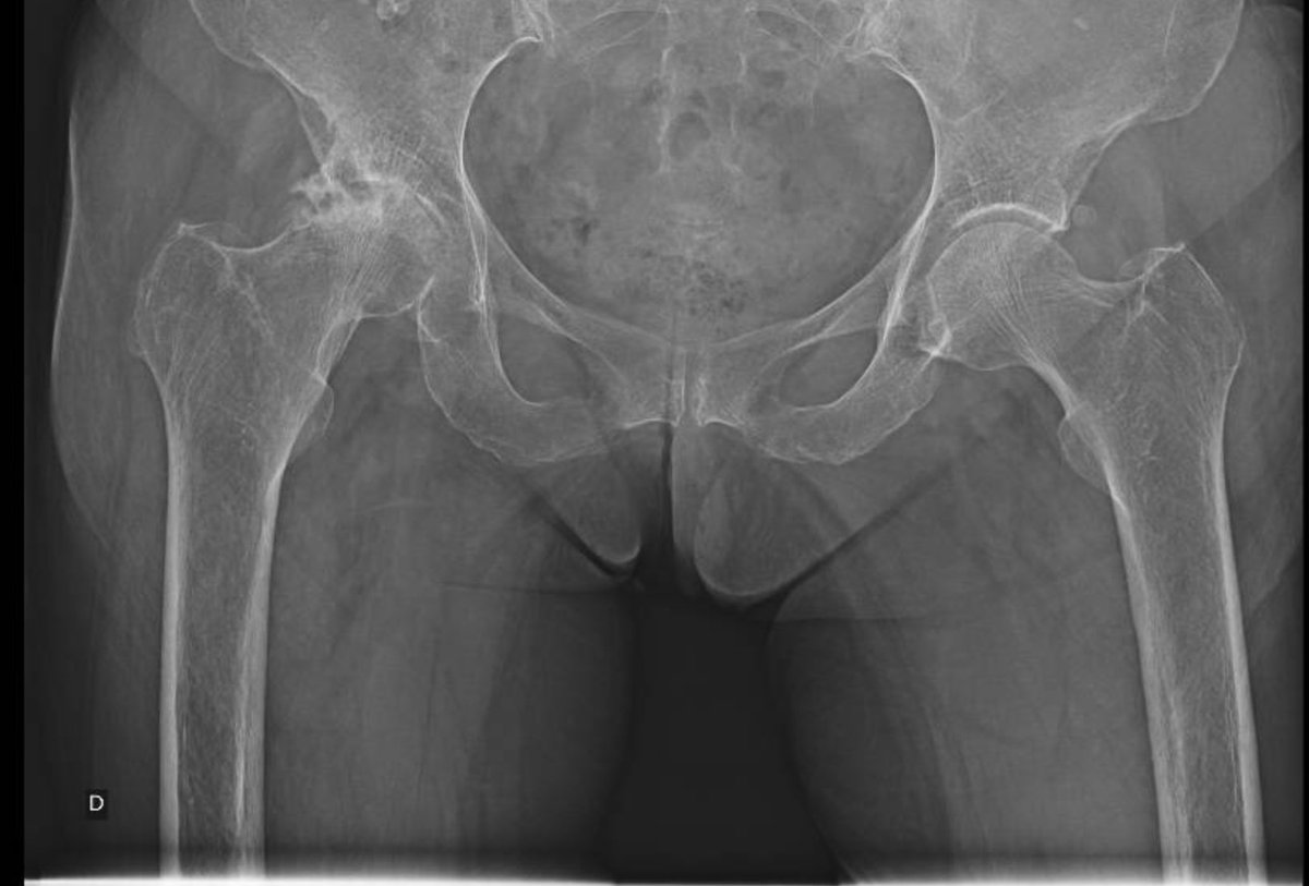 Female,76 y/o
Right hip pain
Would you go with a uncemented or cemented stem?
#Orthotwitter #MedTwitter #orthopedics #totalhipreplacement