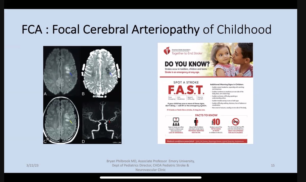 EmoryStroke's tweet photo. Thank you @MdPhilbrook for teaching us about Focal Cerebral Arteriopathy of Childhood  #PediatricStroke @EmoryPediatrics  @AtlPedsResearch @childrensatl https://t.co/alPnESSMav