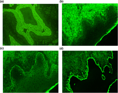 SkinHealthDis's tweet image. #Paraneoplastic #pemphigus has many diagnostic and treatment considerations to take into account; this case series explores diagnostic mimics, confounders and management challenges in a series of five patients #SHD #dermatology doi.org/10.1002/ski2.2…