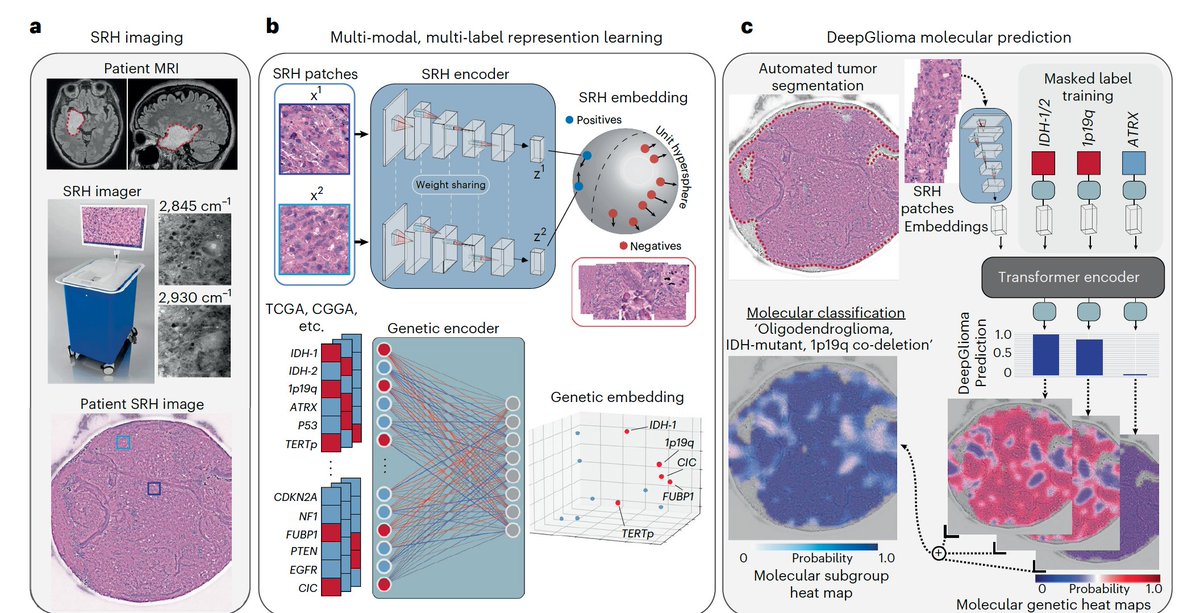 EricTopol's tweet photo. A prospective, multicenter study of label-free #AI classification of brain tumors (diffuse gliomas) with 93% accuracy in <90 seconds
https://t.co/YAt0QZDB2y @NatureMedicine @ToddCHollon @umichneuro @mlins_lab #DeepGlioma https://t.co/BjBN5ZCV29