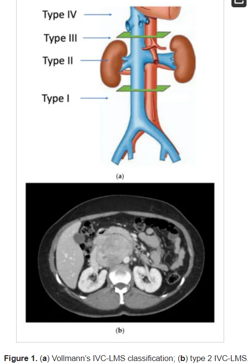 🆕Review - free to read and download
Complex Vascular Resections for Retroperitoneal Soft Tissue #Sarcoma
by Nicolas A. Devaud, Jean M. Butte et al

➡️mdpi.com/1718-7729/30/3…