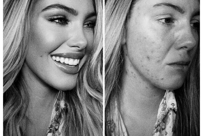 1 of 2: this model posted herself before &amp; after use of filter apps, just so y&rsquo;all see how drastically<a href="/tag/spoilme"class="tags"><span>#spoilme</span></a>