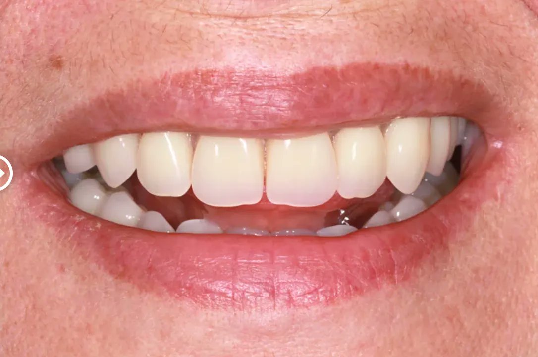 SunshineLEaton's tweet photo. Check out these before &amp; after photos. Lesley came to us looking for a solution to her missing teeth.
With #dentures, we can increase your comfort through improved stability enabling you to, eat, #smile &amp; talk with confidence.

#pearlywhites #dentist #dentalcare #toothreplacement https://t.co/tuzcZTSZGl
