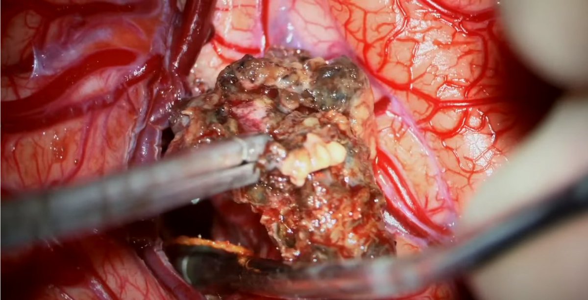mtlawton's tweet photo. Seven Series #4: If there’s one skill I would want every neurosurgeon to master, it’s splitting the Sylvian fissure. Opening this corridor cleanly takes you to important places in the brain and lets you tackle so many lesions – aneurysms, AVMs, tumors, in this case, thalamic cavernomas. https://t.co/z9haCt3cH3
