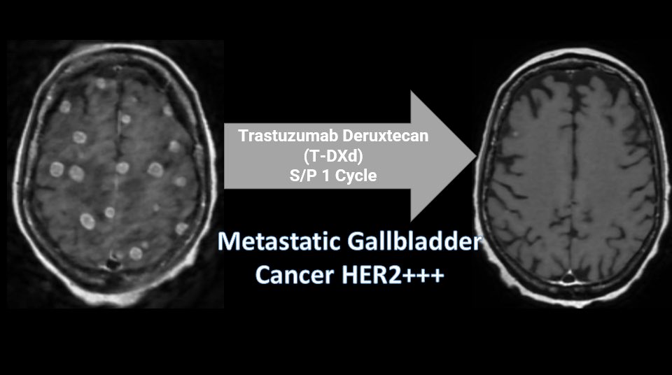Worst nightmare as a patient/oncologist is to deal with brain🧠metastases.

Most drugs don’t penetrate the blood brain barrier &amp; trials often exclude these patients.

👇🏾Our patient with a near complete response after just 1 dose of T-DXd.🙌🏾👏🏾🙌🏾👏🏾

#Cholangiocarcinoma #HER2➕➕➕