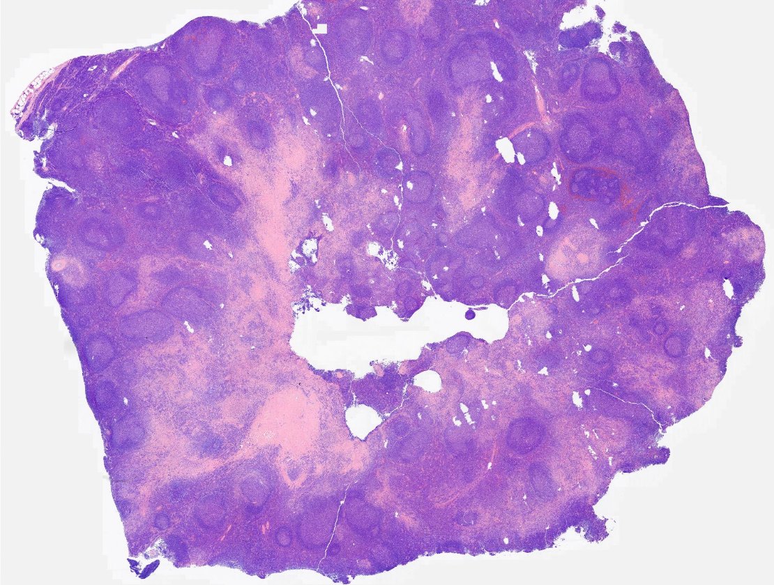 hematogones's tweet image. Great example of IgG4 sclerosing lymphadenopathy
🔸Follicular hyperplasia
🔸Paracortical plasma cells
🔸Fibrosis + storiform pattern
🔸May be isolated, part of systemic disease or 2nd to other pathologies
Nice review by @Vik_deshpandeMD : pubmed.ncbi.nlm.nih.gov/32889888/

#hemepath