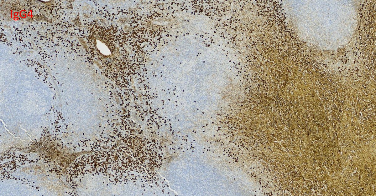 hematogones's tweet image. Great example of IgG4 sclerosing lymphadenopathy
🔸Follicular hyperplasia
🔸Paracortical plasma cells
🔸Fibrosis + storiform pattern
🔸May be isolated, part of systemic disease or 2nd to other pathologies
Nice review by @Vik_deshpandeMD : pubmed.ncbi.nlm.nih.gov/32889888/

#hemepath