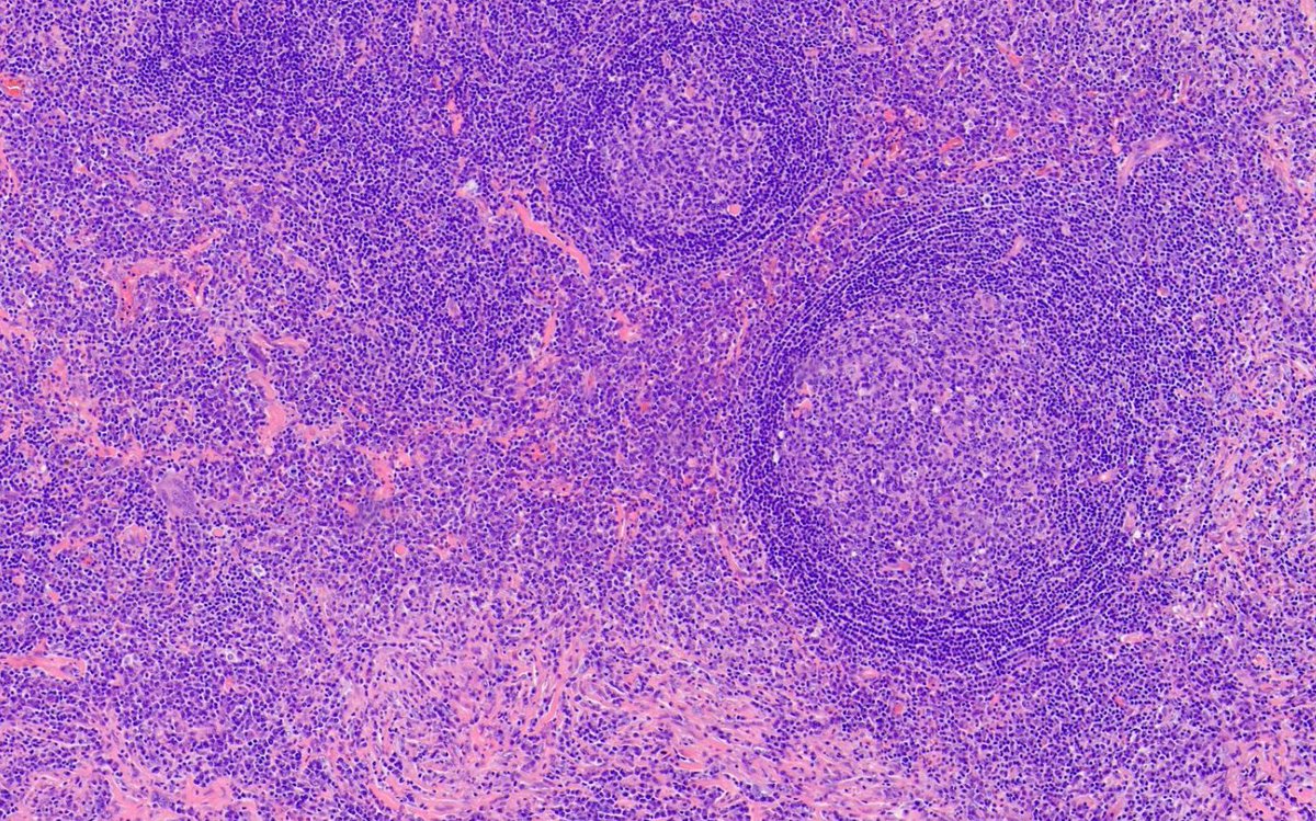 hematogones's tweet image. Great example of IgG4 sclerosing lymphadenopathy
🔸Follicular hyperplasia
🔸Paracortical plasma cells
🔸Fibrosis + storiform pattern
🔸May be isolated, part of systemic disease or 2nd to other pathologies
Nice review by @Vik_deshpandeMD : pubmed.ncbi.nlm.nih.gov/32889888/

#hemepath