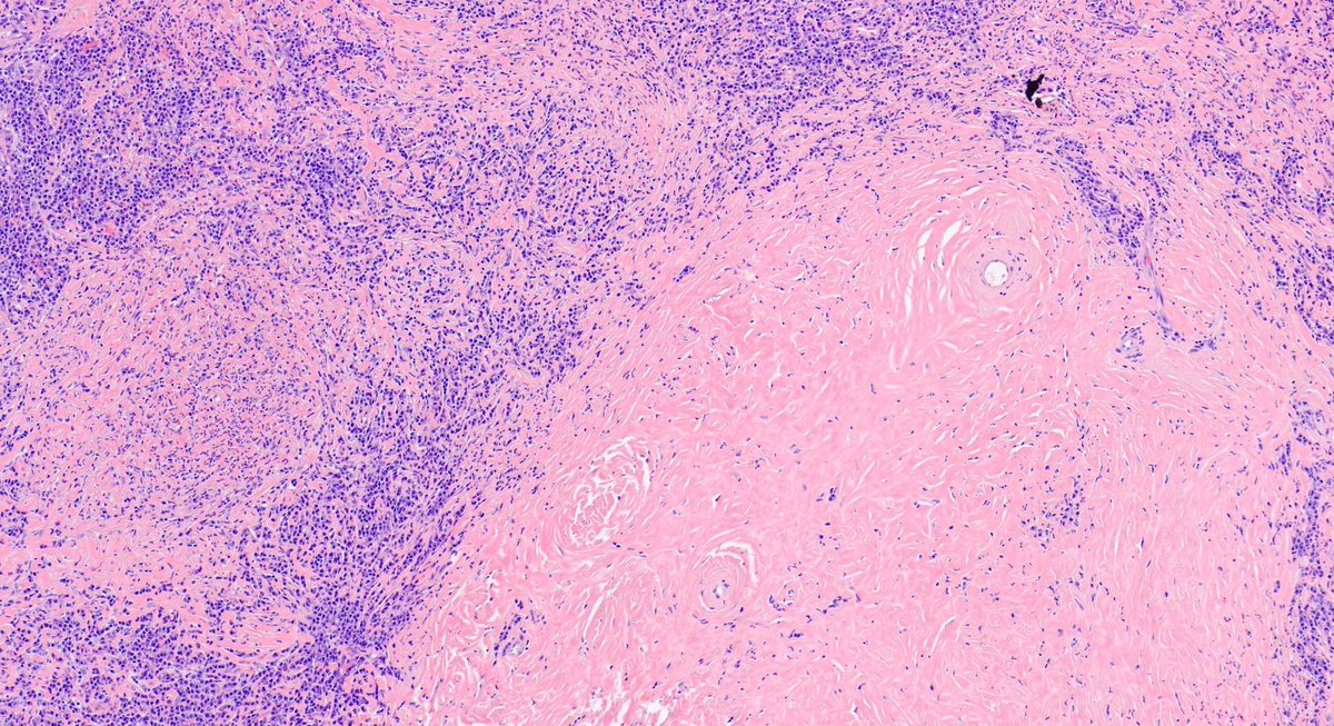 hematogones's tweet image. Great example of IgG4 sclerosing lymphadenopathy
🔸Follicular hyperplasia
🔸Paracortical plasma cells
🔸Fibrosis + storiform pattern
🔸May be isolated, part of systemic disease or 2nd to other pathologies
Nice review by @Vik_deshpandeMD : pubmed.ncbi.nlm.nih.gov/32889888/

#hemepath