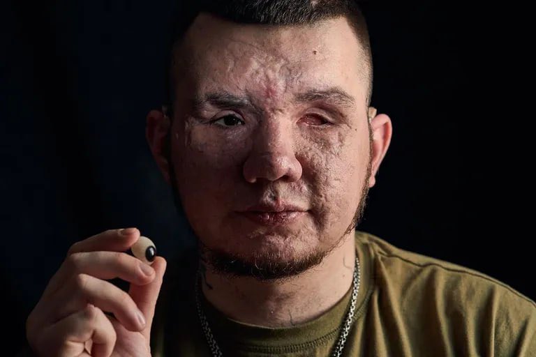 TreasChest's tweet photo. 💔A Ukrainian sapper lost both eyes after the explosion of an anti-personnel mine

Vladyslav voluntarily went to fight in the first weeks of the full-scale invasion. The man joined the sappers.

According to his commander, who saw the incident, the man miraculously survived.

Vladyslav is supported by his fiancée Valeria. Now the couple will learn about all possible experimental ways to restore vision.

We wish Vlad health 🙏

📷: Vladyslav and Kostyantyn Liberov

Channel 24