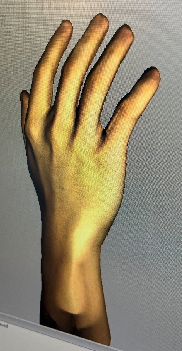 c_cvetkovic's tweet photo. From imaging data, to concept, to design, to final product! (With a few iterations in between…) Students in Biofabrication Lab (BIOE 306) created patient-specific 3D printed wrist braces with a customized locking mechanism. @BIOENGatIL @uofigrainger 🩻🦾🥼 https://t.co/EbXf2a1suI