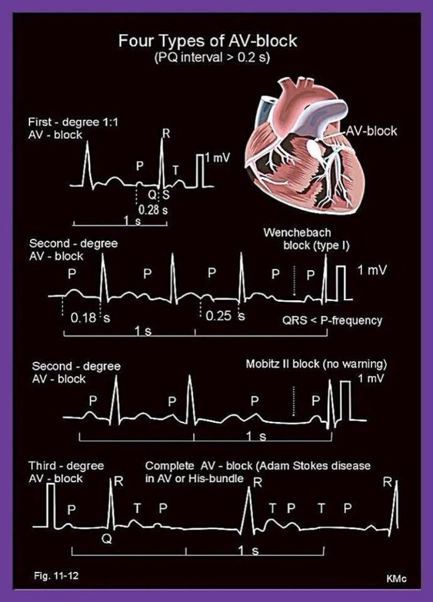 Types of AV Blocks #MedTwitter #medEd