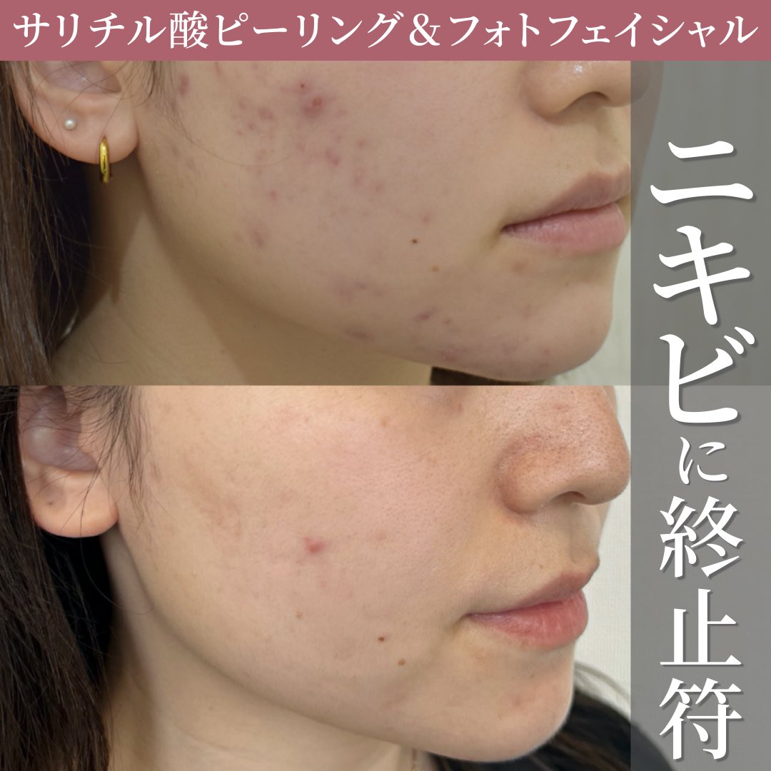 IPL光治療の口コミ分析まとめ|効果・副作用・満足度を徹底比較