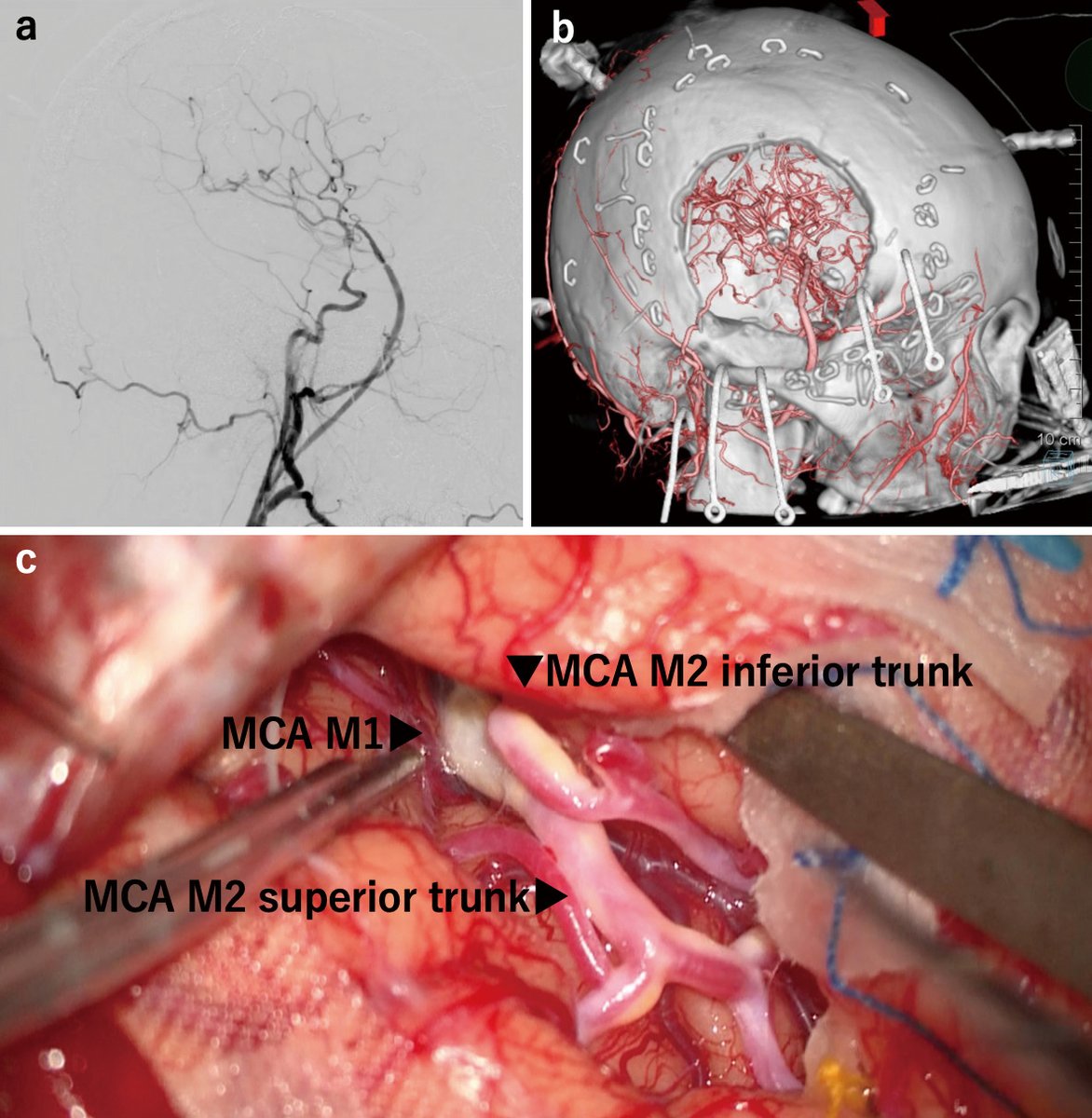 New Arrival: Tyrosine Kinase Inhibitor-associated Cerebral Arterial Occlusive Disease Treated with High-flow Bypass Surgery: A Case Report
doi.org/10.2176/jns-nm…
#BypassSurgery #TyrosineKinaseInhibitor #Nilotinib #CerebralArteryDisease #Bcr_abl #ChronicMyeloidLeukemia
