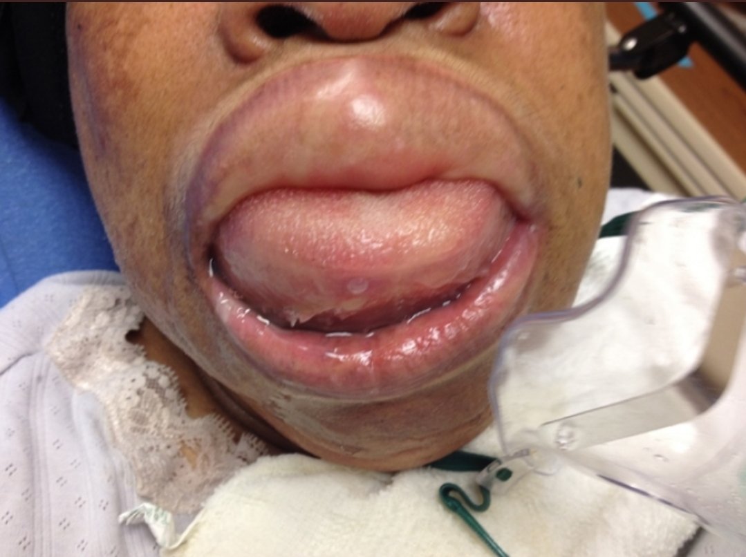 Angioedema due to sacubitril / valsartan 

 increaed bradykinin