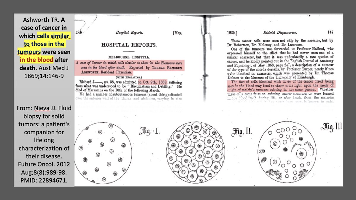 pashtoonkasi's tweet image. 👇🏾Isn’t this amazing?

We are talking about Circulating Tumor Cells➖#CTCs🔵🟣🟡in blood🩸of patients with #Cancer now in 2023, whereas the 1st description of this was published in📰1️⃣8️⃣6️⃣9️⃣!

Yes! 1869!

Also, love the narrative: “I showed it to Prof👩‍🏫 X &amp;amp; 👨‍🏫 Z, &amp;amp; they agree.”😊
