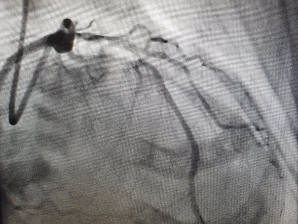 AsherElad's tweet photo. CS (coronary orbital atherectomy  system) 
for LAD calcified lesion with @ramii125  @PCRonline @Sbrugaletta @Ortega_Paz @aayshacader @Anazmicalik @guilbom @hect2701 @NicolaRyanI1 @DrPascalMeier @W_jyg @ICigalini @GreggWStone @mmamas1973 @djc795 @SABOURETCardio https://t.co/NZKU6ywJP9