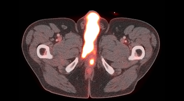 YAU Working Group Penile & Testis Cancer (@yaupenile_tesca) on Twitter photo Want to know more about corporal skip metastases in penile cancer?
Attend the penile cancer abstract session at 2PM where <a href="/ElstLaura/">Laura Elst</a> will demonstrate that these lesions display a distinct pattern of spread with poor prognosis.
A0637 #EAU23 #SkipMetastases #PenileCancer Want to know more about corporal skip metastases in penile cancer?
Attend the penile cancer abstract session at 2PM where <a href="/ElstLaura/">Laura Elst</a> will demonstrate that these lesions display a distinct pattern of spread with poor prognosis.
A0637 #EAU23 #SkipMetastases #PenileCancer