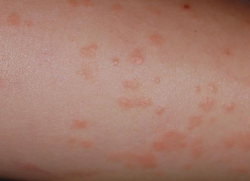 familiaysalud's tweet photo. Síndrome de Gianotti-Crosti
Erupción cutánea infantil, causada sobre por virus. Se distribuye de forma simétrica en mejillas, brazos y piernas. Suele tener un curso benigno.
Otras denominaciones 
Causas
Síntomas
Complicaciones
Diagnóstico
Tratamiento
https://t.co/U0cokFaYRO https://t.co/EhtNmi88IX