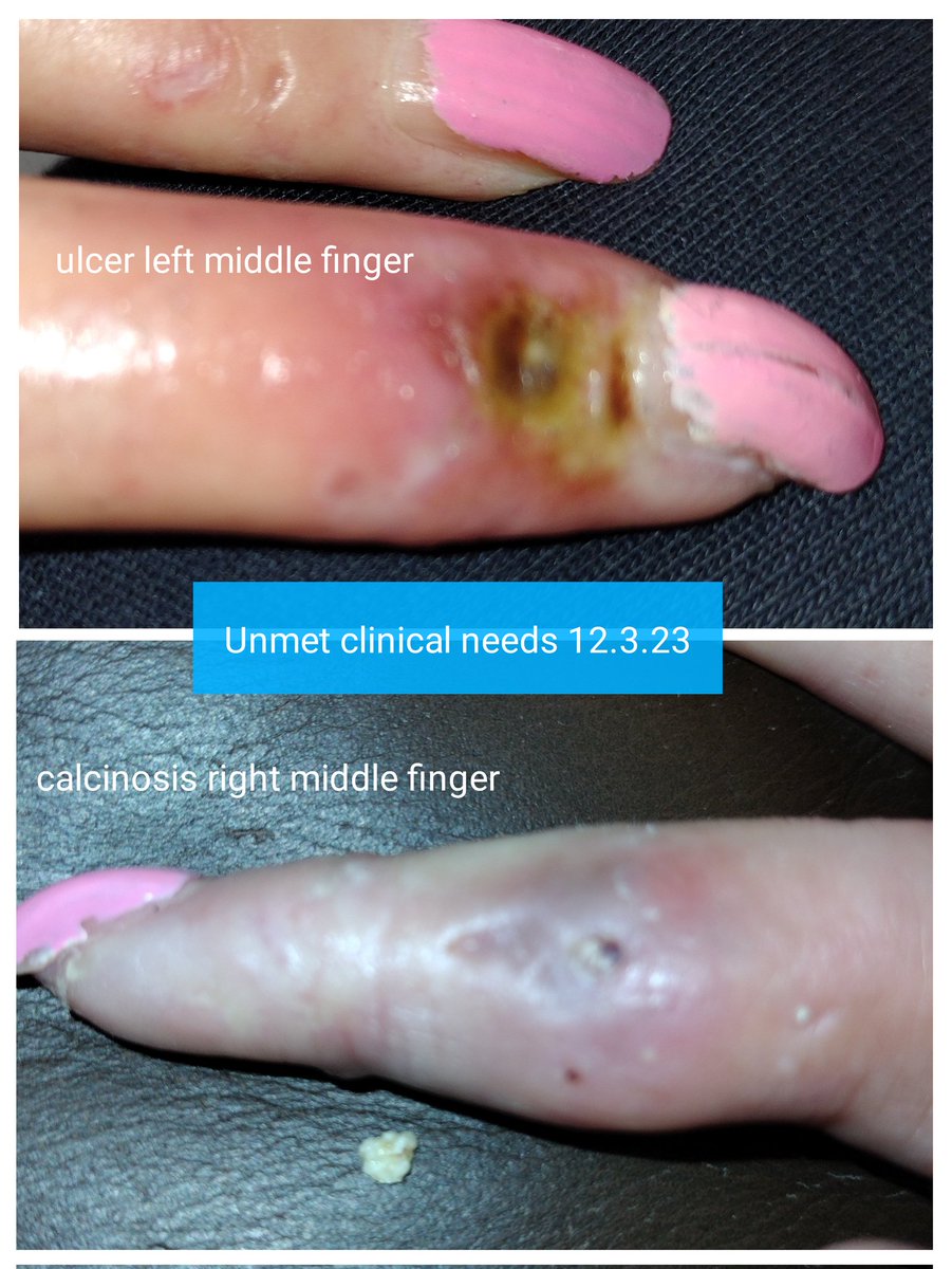 cosmicfairy444's tweet photo. #AutoimmuneDiseaseAwarenessMonth
Unmet needs:
https://t.co/5GUmiopnsL
#SclerodermaFreeWorld #RaynaudsFreeWorld #Research #RareDisease #NoCure #UnknownCause #LifeChanging #SystemicSclerosis #Raynauds #ConnectiveTissue #Pain #DigitalUlcers #Calcinosis
#Scleroderma #CareForRare https://t.co/Xp3eXMVaiP