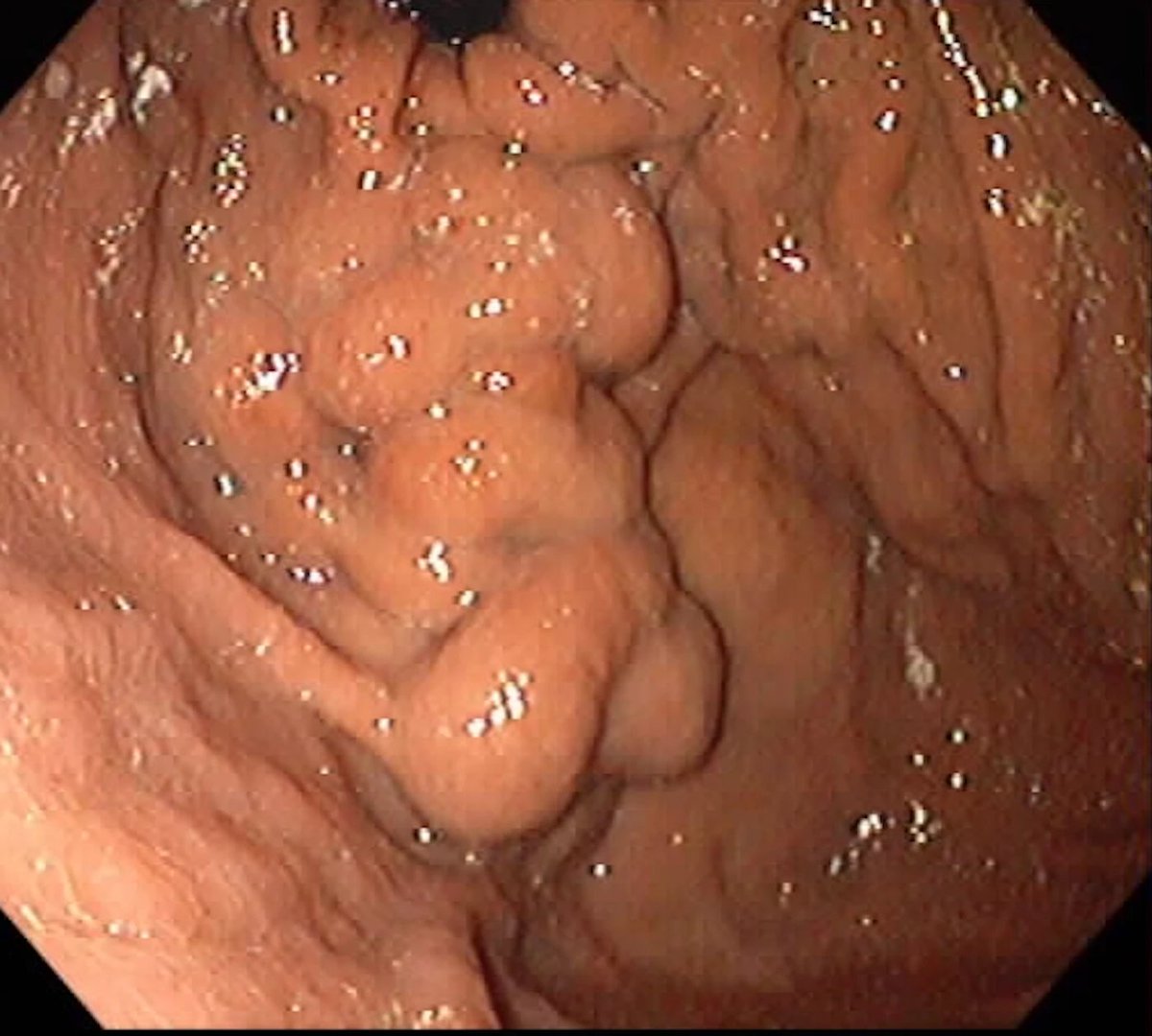 EndoCollab™ | GI Endoscopy Community tweet media