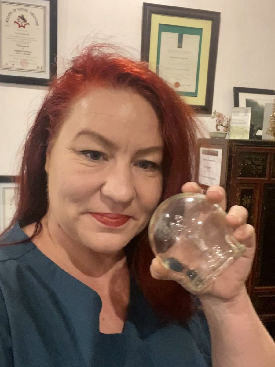 Acupuncture &amp; cupping is a big part of what I do in my practice… book via : metrohealth.com.au/clinic/