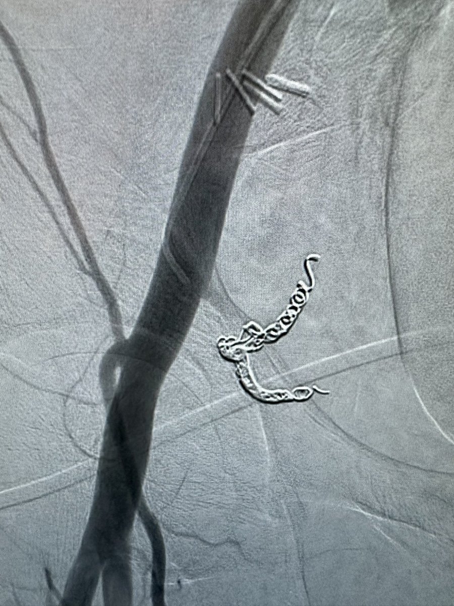 Aaron DuCoffe, MD (@drdukesvir) on Twitter photo Dear <a href="/SIRspecialists/">Society of Interventional Radiology</a>, <a href="/SIR_ECS/">SIR ECS</a>, <a href="/SIRRFS/">SIR RFS</a>, #twitir, <a href="/FutureVascSurgn/">FutureVascSurgeons</a>, <a href="/VascularSVS/">Vascular SVS</a>, <a href="/STS_CTsurgery/">The Society of Thoracic Surgeons</a>, <a href="/ACCinTouch/">American College of Cardiology</a> and anyone else who currently or aspires to access groins,
Respect the 👑☠️. #variants
Sincerely,
<a href="/DrDukesVIR/">Aaron DuCoffe, MD</a> Dear <a href="/SIRspecialists/">Society of Interventional Radiology</a>, <a href="/SIR_ECS/">SIR ECS</a>, <a href="/SIRRFS/">SIR RFS</a>, #twitir, <a href="/FutureVascSurgn/">FutureVascSurgeons</a>, <a href="/VascularSVS/">Vascular SVS</a>, <a href="/STS_CTsurgery/">The Society of Thoracic Surgeons</a>, <a href="/ACCinTouch/">American College of Cardiology</a> and anyone else who currently or aspires to access groins,
Respect the 👑☠️. #variants
Sincerely,
<a href="/DrDukesVIR/">Aaron DuCoffe, MD</a>