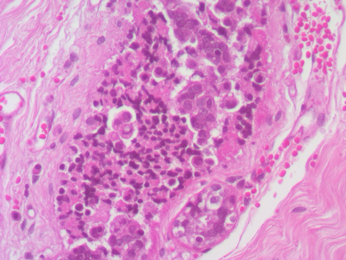 ariella8's tweet image. 1/ Dear #Breastpath your input on this axillary accessory breast, late 20's 
some findings  seem artifactual discohesiveness but some big nuclei is of concern
a lot of different columnar cell changes/blunt duct adenosis too, see next posts 😊🙏