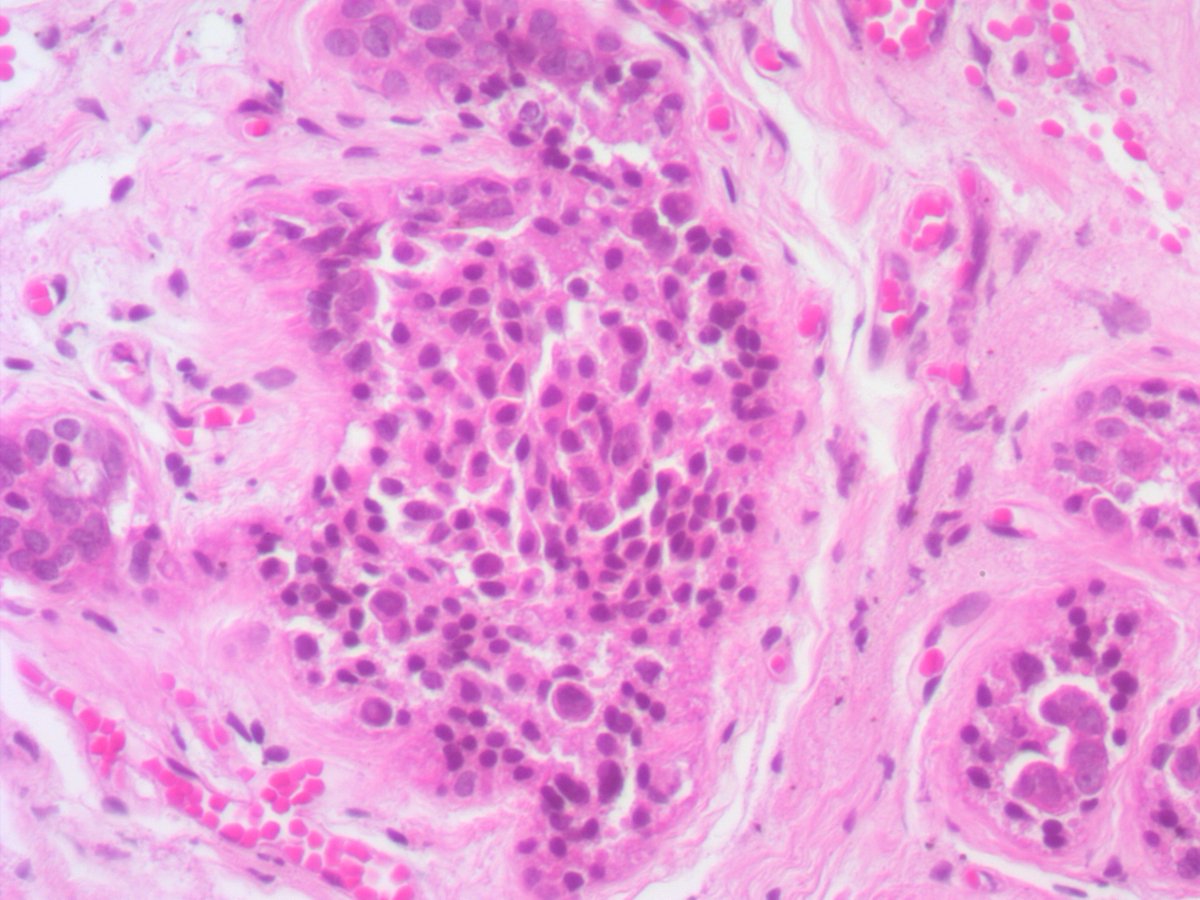 ariella8's tweet image. 1/ Dear #Breastpath your input on this axillary accessory breast, late 20's 
some findings  seem artifactual discohesiveness but some big nuclei is of concern
a lot of different columnar cell changes/blunt duct adenosis too, see next posts 😊🙏