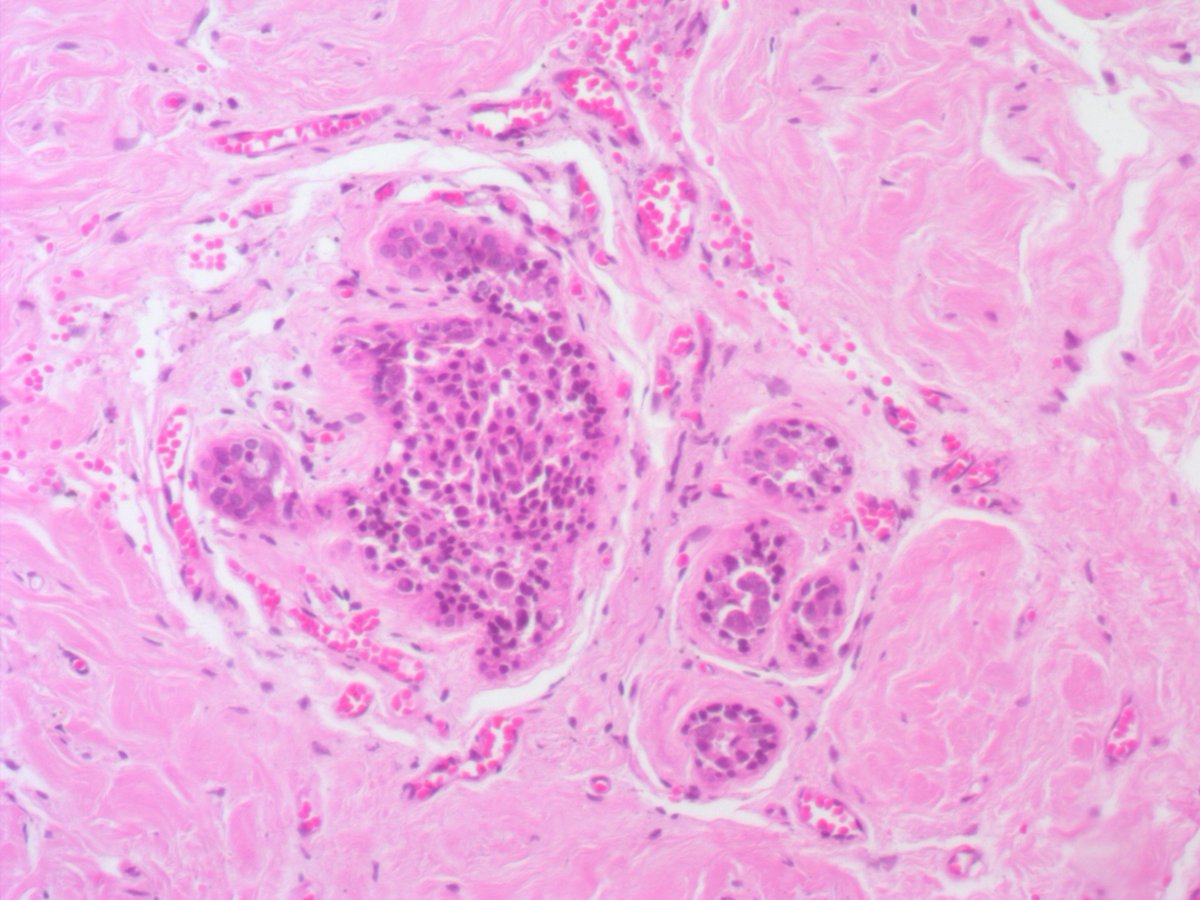 ariella8's tweet image. 1/ Dear #Breastpath your input on this axillary accessory breast, late 20's 
some findings  seem artifactual discohesiveness but some big nuclei is of concern
a lot of different columnar cell changes/blunt duct adenosis too, see next posts 😊🙏