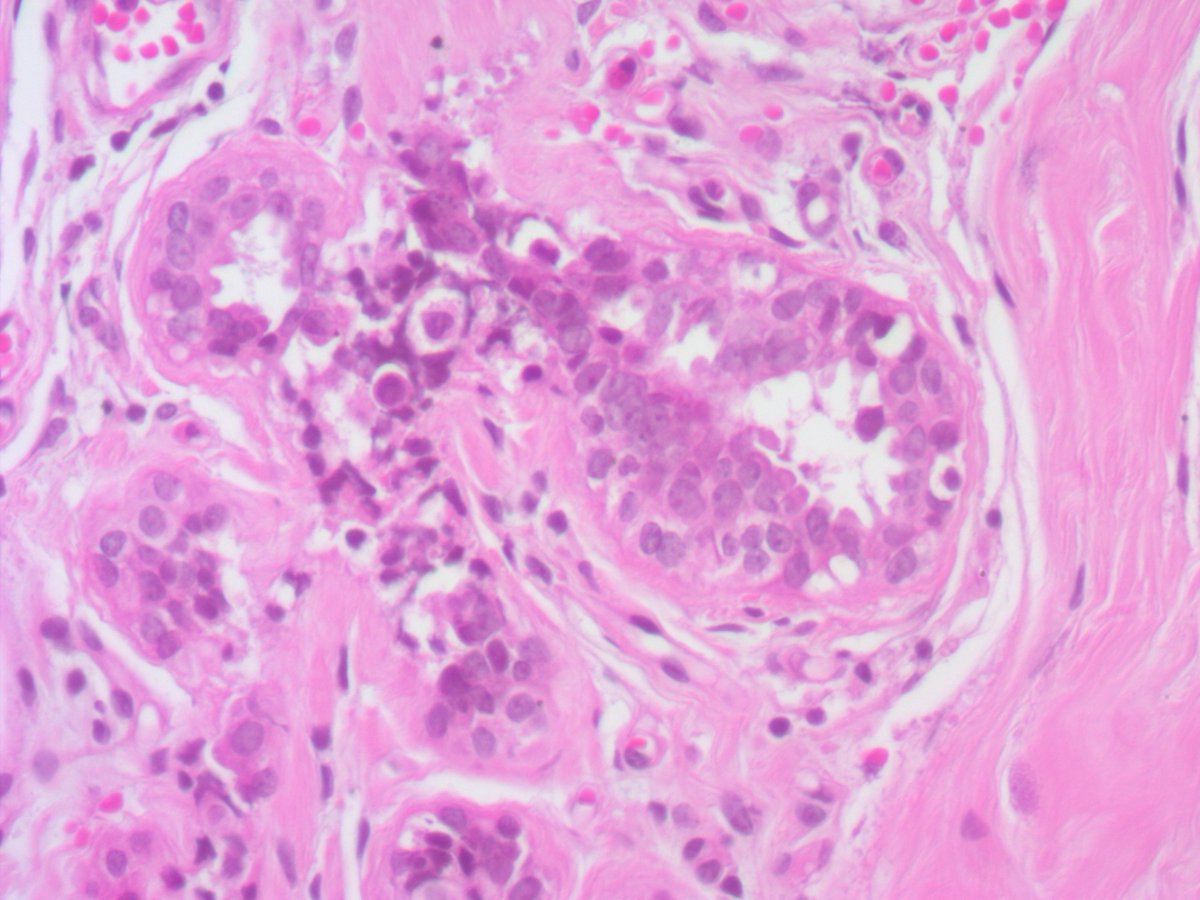 ariella8's tweet image. 1/ Dear #Breastpath your input on this axillary accessory breast, late 20's 
some findings  seem artifactual discohesiveness but some big nuclei is of concern
a lot of different columnar cell changes/blunt duct adenosis too, see next posts 😊🙏