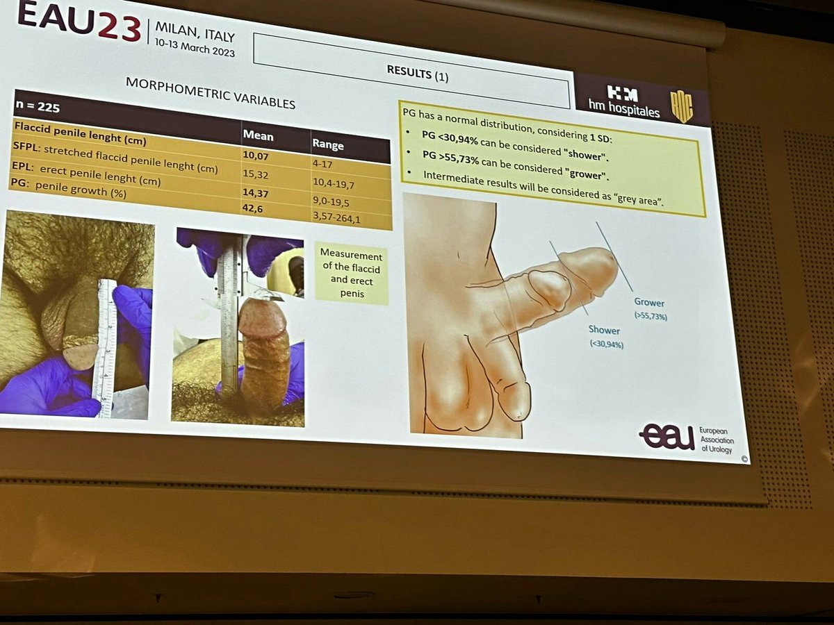 Manuel Alonso Isa (@manuelalonsouro) on Twitter photo Studies on the penile morphometry allow us to achieve knowledge that can be very useful when advising and treating our patients. We can adjust pre and post surgical expectations and this type of knowledge is useful for the management of dysmorphophobia
#EAU23
<a href="/ROC_Urologia/">ROC Clinic</a> Studies on the penile morphometry allow us to achieve knowledge that can be very useful when advising and treating our patients. We can adjust pre and post surgical expectations and this type of knowledge is useful for the management of dysmorphophobia
#EAU23
<a href="/ROC_Urologia/">ROC Clinic</a>
