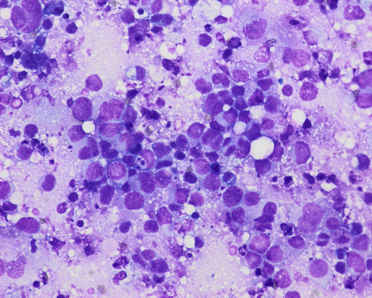 pepeheffernan's tweet image. CC263. Gloomy Sunday case. Intraoperative from neurosurgery. In his 60s. CT: glioblastoma or metastasis. No relevant history.
-Pepe would you take a look?
-Of course
@premcharles @LoboAnandi @dr_amenona @DrBMcGinn @vincepolizzi @edusqo @vi_monappa @sarahjwu