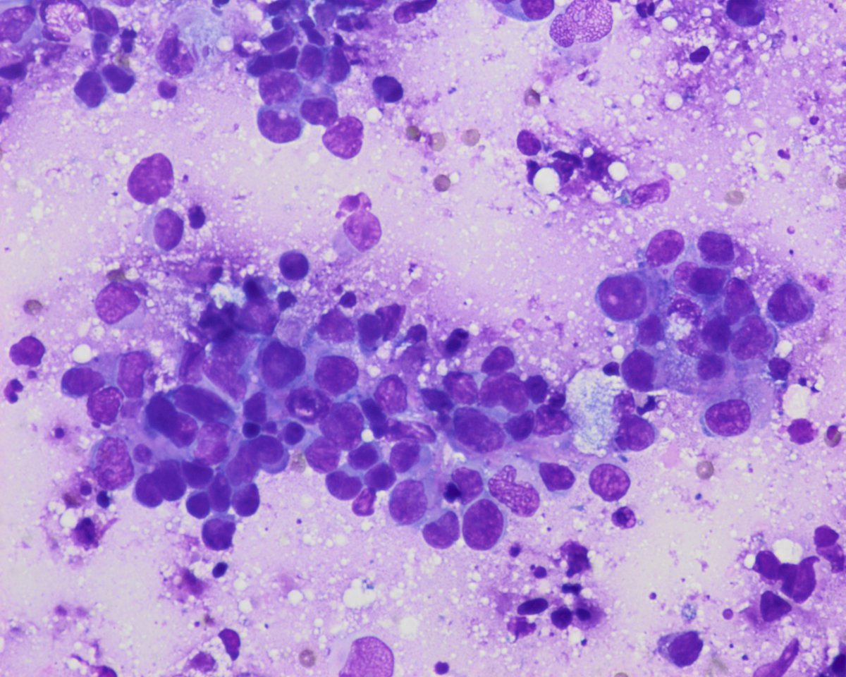pepeheffernan's tweet image. CC263. Gloomy Sunday case. Intraoperative from neurosurgery. In his 60s. CT: glioblastoma or metastasis. No relevant history.
-Pepe would you take a look?
-Of course
@premcharles @LoboAnandi @dr_amenona @DrBMcGinn @vincepolizzi @edusqo @vi_monappa @sarahjwu