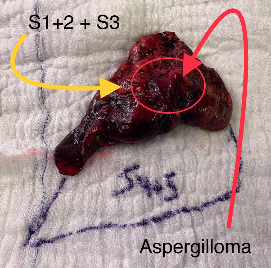 We performed two complex anatomical resections at SSMC using uniportal perimammary incision last week on a patient with lung cancer s/p neoadjuvant chemo+immunotherapy and in another patient with Aspergilloma in the setting of prior Tb. Excellent exposure with great recovery!