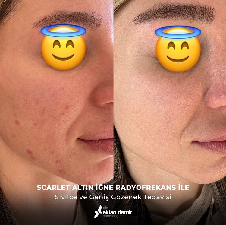 #Altıniğne ameliyatsız cilt gençleştirme, etkili cilt yenileme tekniklerindendir. 💛Cilt altına iletilen #radyofrekans dalgaları kolajen üretimini tetikler. Böylece ciltte sıkılaşma, parlaklık ve yenilenme sağlanır.💉
ektandemir.com/altin-igne-ame…

#ciltgençleştirme #istanbul #scarlets