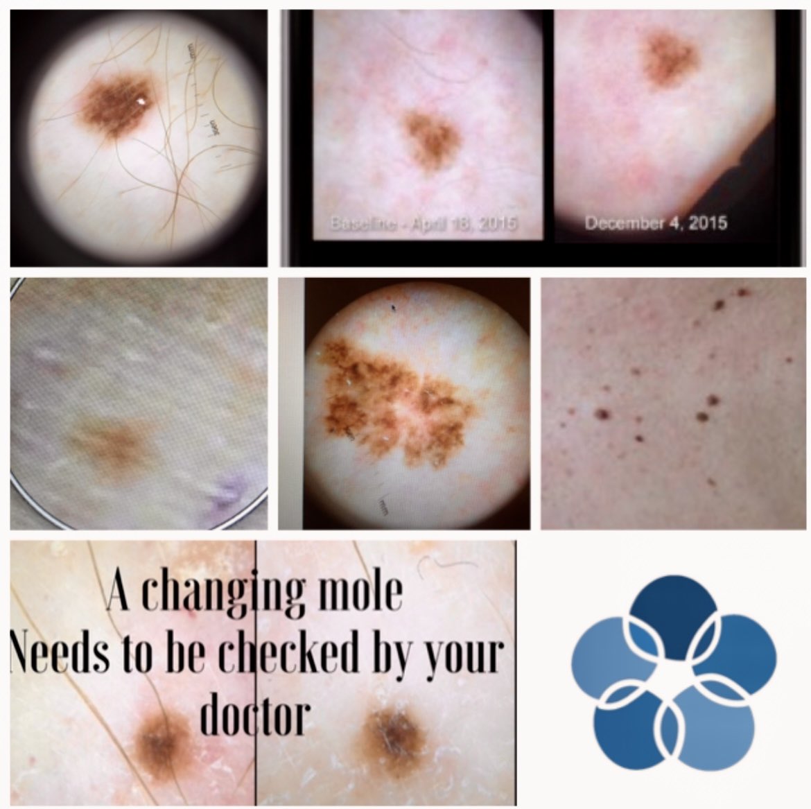 When was your last skin check?
Melanoma kills almost one American each hour.
Take baseline pictures to help detect a new or changing mole. #melanoma #healthTech